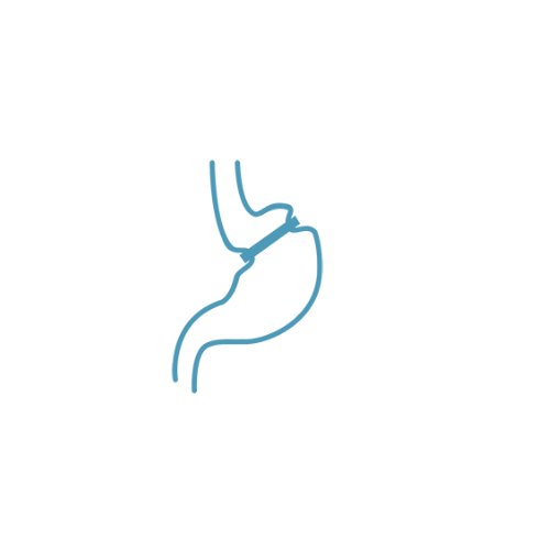 Gastric band removal