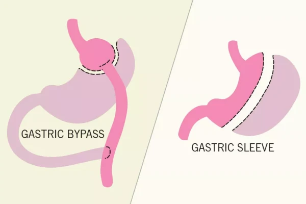 Sleeve Gastrectomy